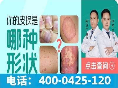 苏州有哪些银屑病医院